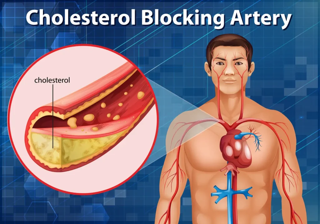 Imagen del corazón con arterias afectadas por colesterol alto - clinica de insuficiencia cardiaca